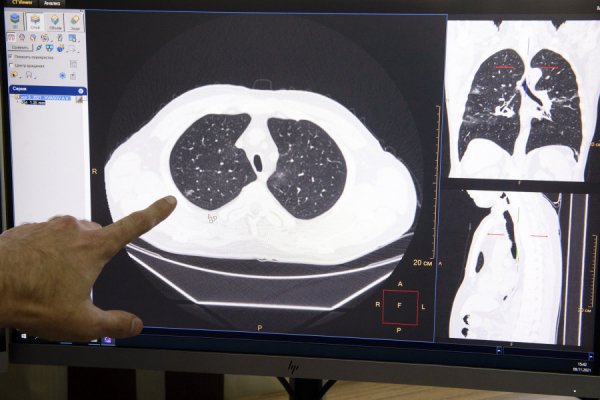 50 оттенков пневмонии. Главный рентгенолог Алтайского края — о взрывных томографах и ковидных легких